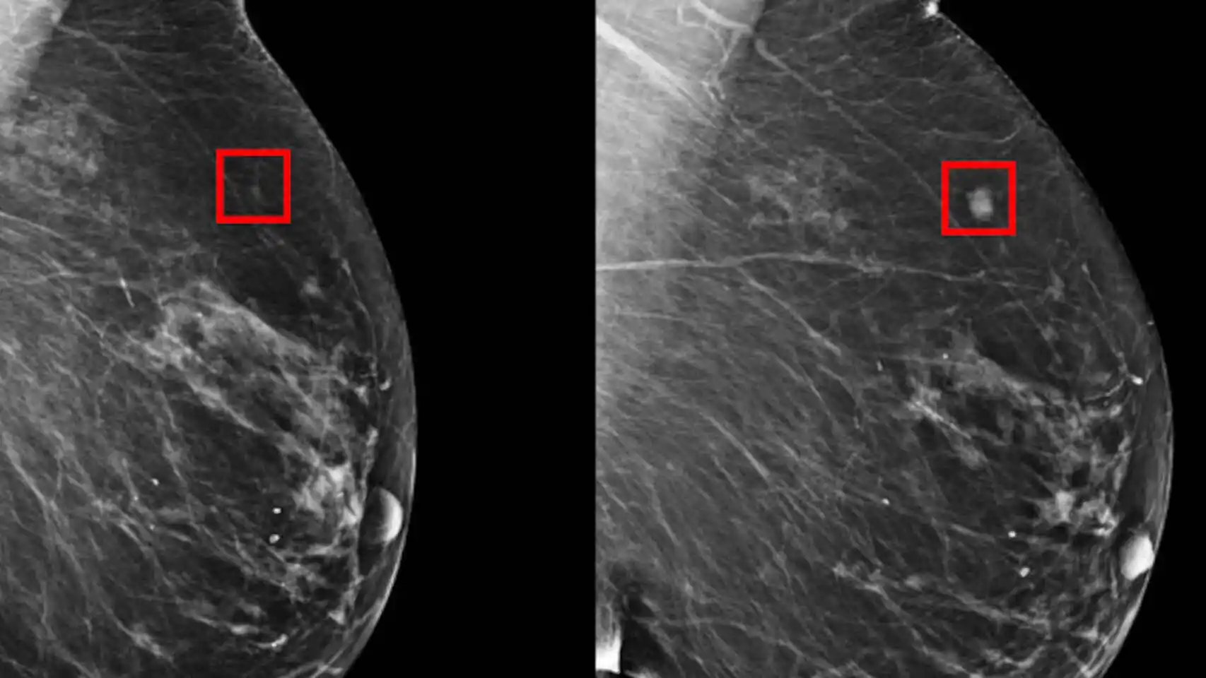 Síntomas desconocidos del cáncer de mama, el más frecuente en mujeres